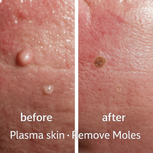 Before and After Plasma Mole Removal Punta Gorda FL

