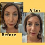 Remove and Reshape Bad Eyebrow Tattoos