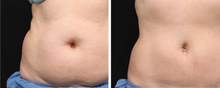 Body Contouring1