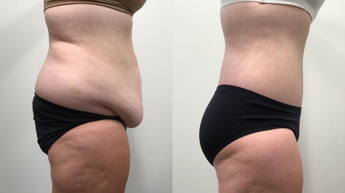 Body Contouring3