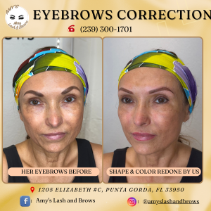 Plasma Fibroblast – Non-Surgical Skin Lifting & Rejuvenation
