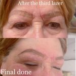 "Eyebrow tattoo correction with laser removal before and after