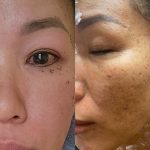 Plasma fibroblast acne scar treatment Florida