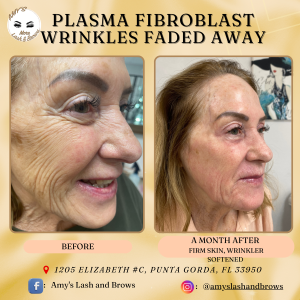 Plasma Fibroblast - Non-Surgical Skin Lifting & Rejuvenation 2 Plasma Fibroblast wrinkle removal before and after in Punta Gorda