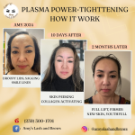 Before and after results of Plasma Fibroblast skin tightening at Amy’s Lash and Brows Punta Gorda – non-surgical facelift treatment.