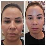 Plasma Fibroblast Skin Rejuvenation – Amy Lash and Brows Punta Gorda FL
