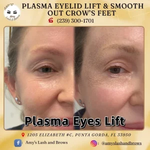 Non- Surgical Eyelid Lift in Punta Gorda FL — What Is Plasma Skin Tightening? 1 Plasma Fibroblast Eyelid and Skin Lift – Amy Lash and Brows Punta Gorda