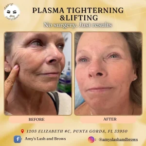 Plasma Fibroblast Wrinkle Removal – Amy Lash and Brows Florida