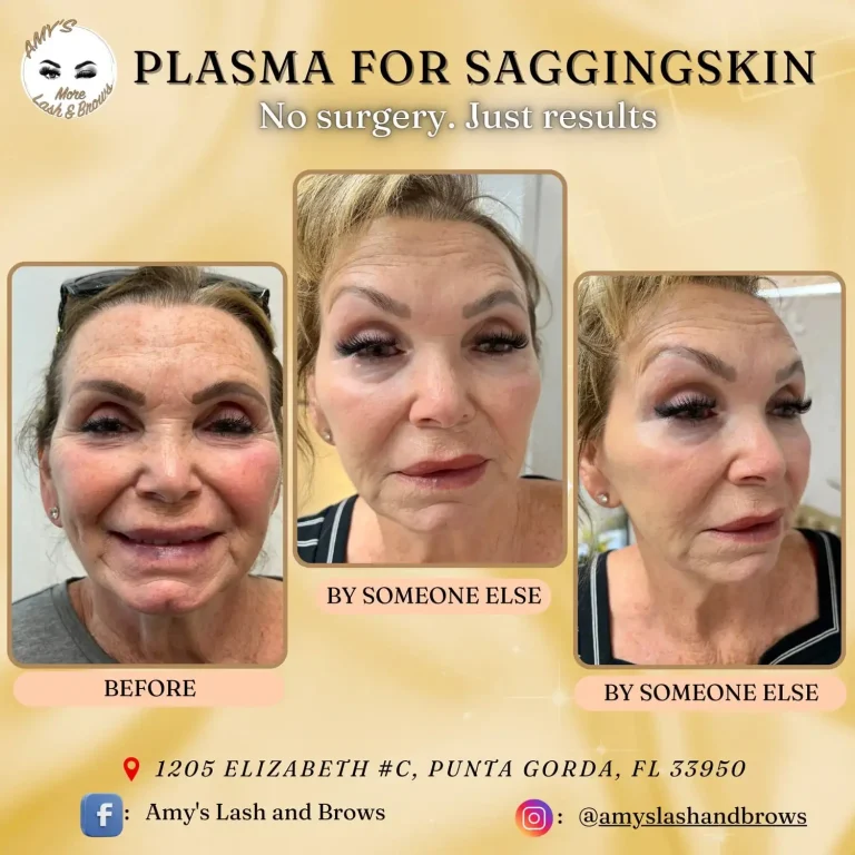 Plasma Skin Treatment 41 plasma5a-min