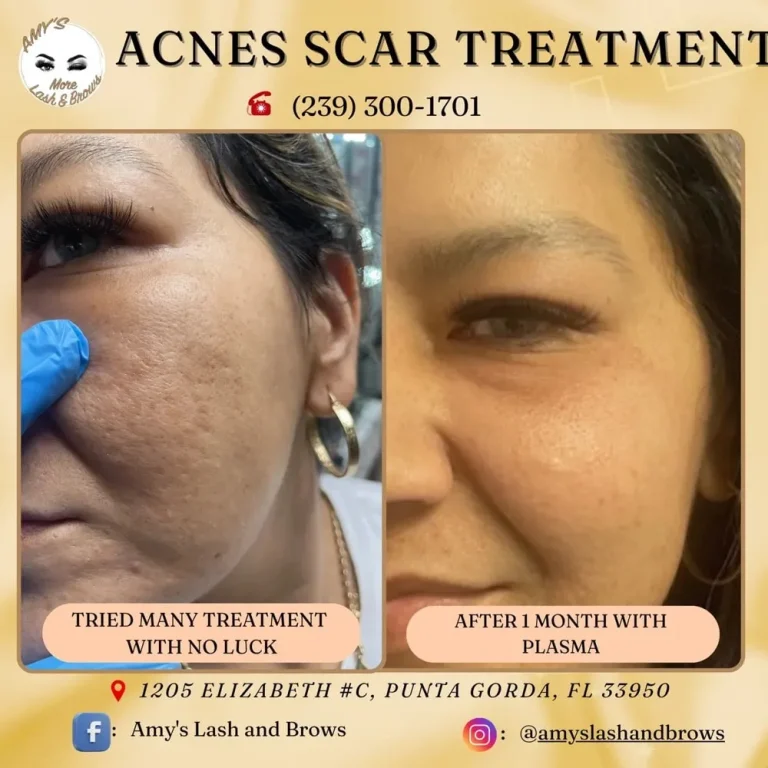 Plasma Skin Treatment 44 plasma9a-min