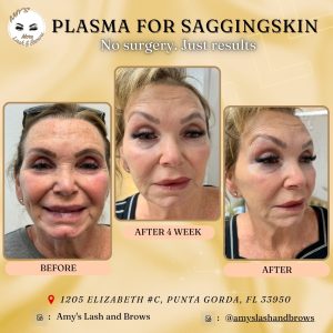 Tighten Loose Skin Naturally – Discover Plasma Fibroblast in Punta Gorda 4 Find Your Find Your Perfect Eyebrow Shape | Ombre Brows Punta Gorda
