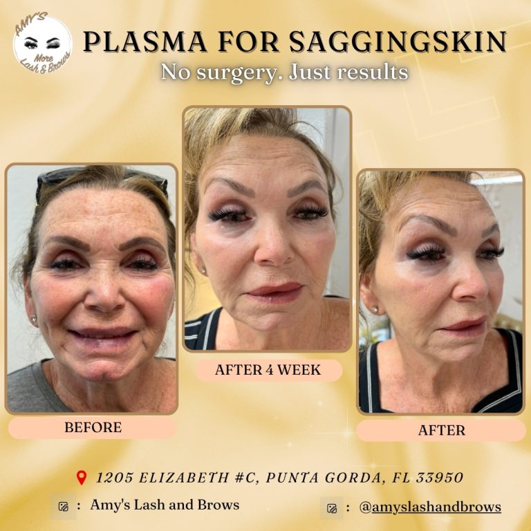 Before and after 4 weeks of Plasma Fibroblast skin tightening treatment at Amy’s Lash & Brows in Punta Gorda, showing smoother, firmer, and rejuvenated